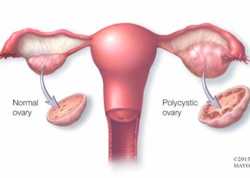 PCOS чи навъ беморӣ аст?
