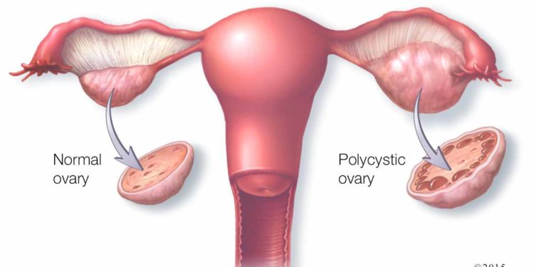 PCOS чи навъ беморӣ аст?